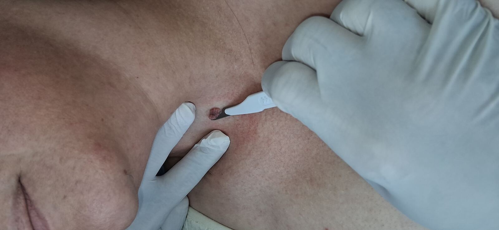 Antes - Caso clínico: Nevus verrucoso