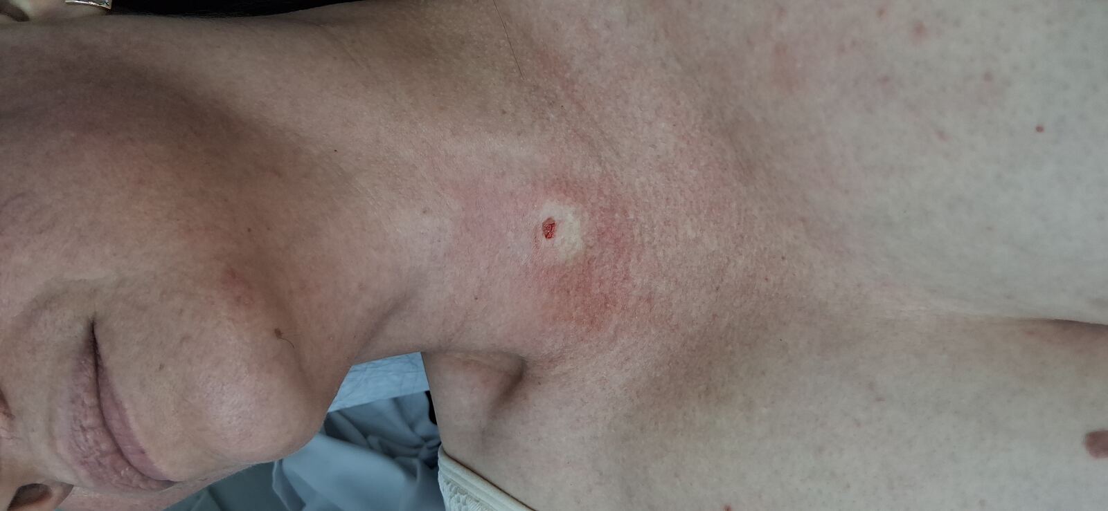 Después - Caso clínico: Nevus verrucoso