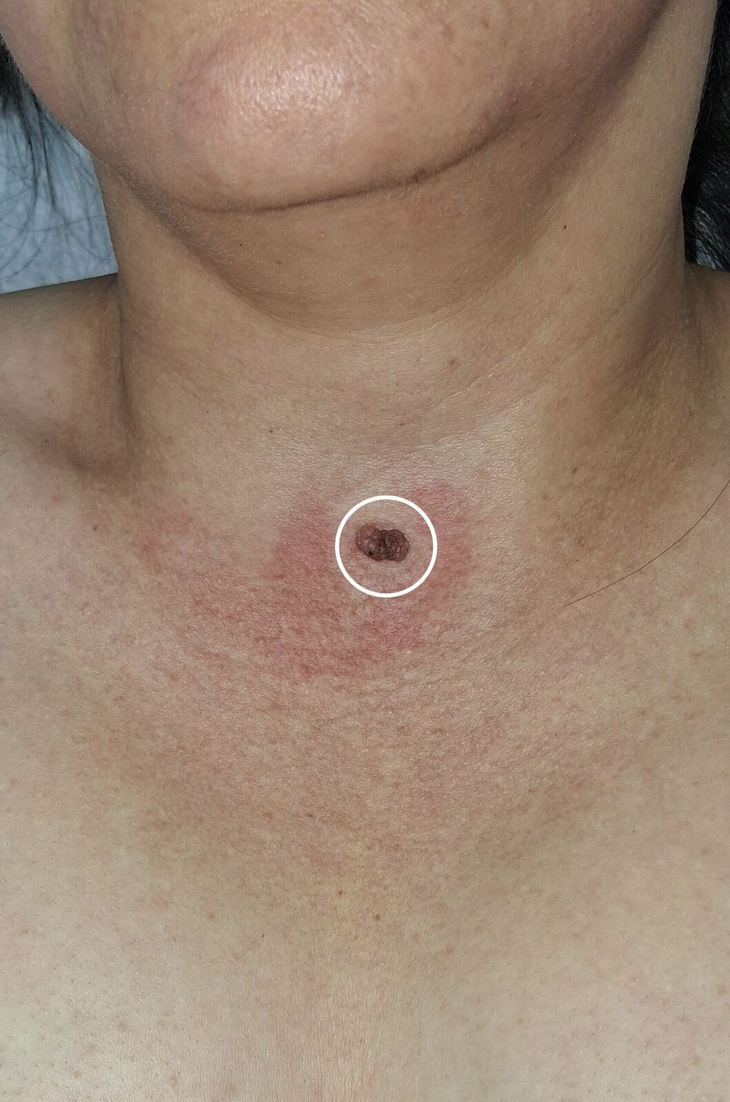 Caso clínico: Nevus verrucoso