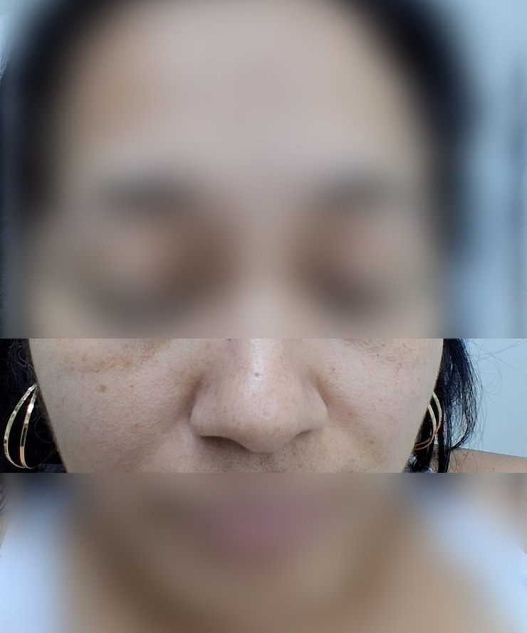 Antes - Caso clínico: Nevus vs carcinoma basocelular