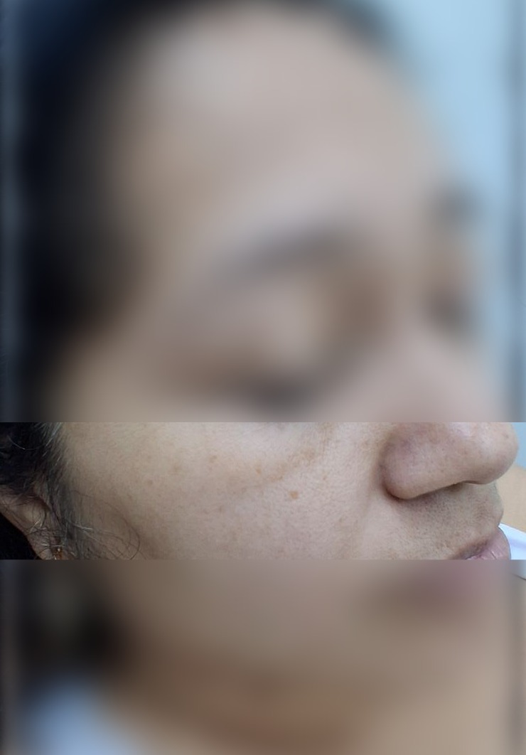 Después - Caso clínico: Nevus vs carcinoma basocelular