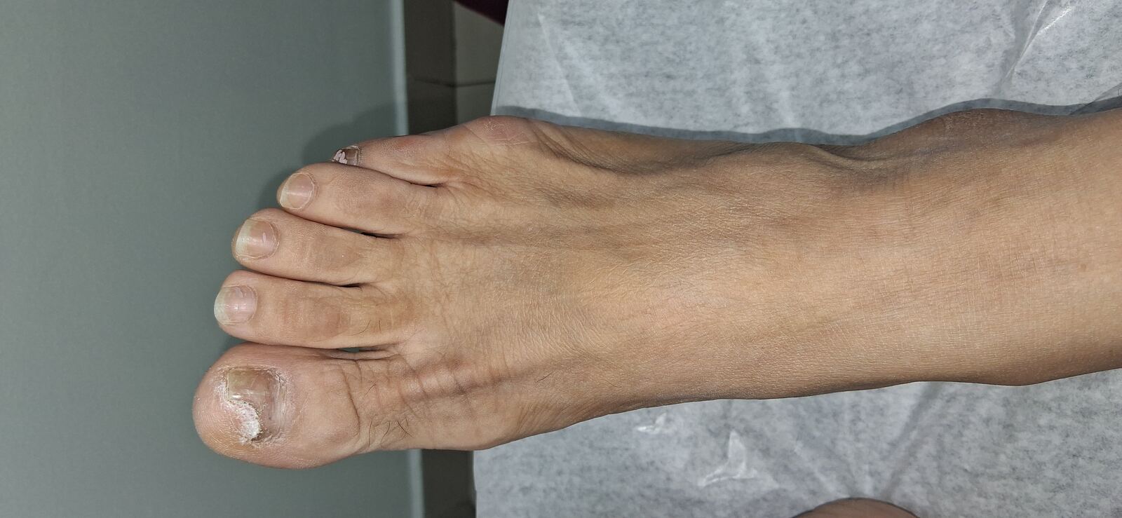 Antes - Caso clínico: Onicomicosis en manos y pies