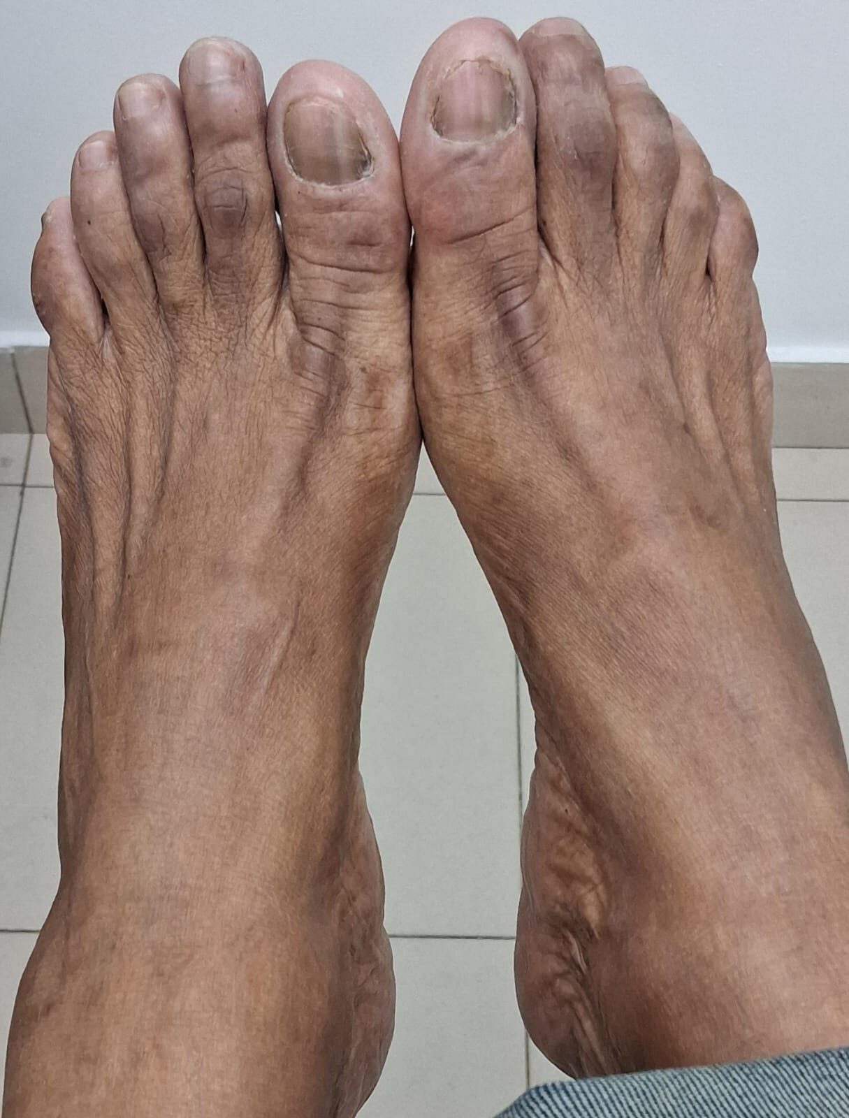 Después - Caso clínico: Onicomicosis en manos y pies