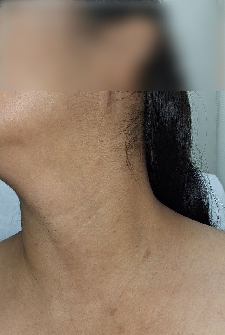 Antes - Caso clínico: Pitiriasis rosada