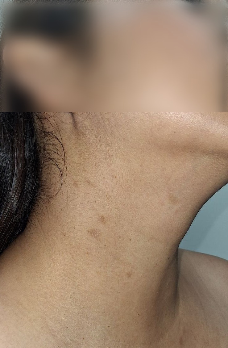 Caso clínico: Pitiriasis rosada