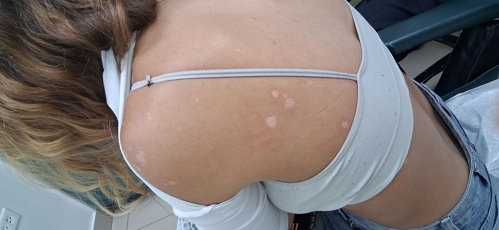 Antes - Caso clínico: Pitiriasis versicolor e hipomelanosis guttata