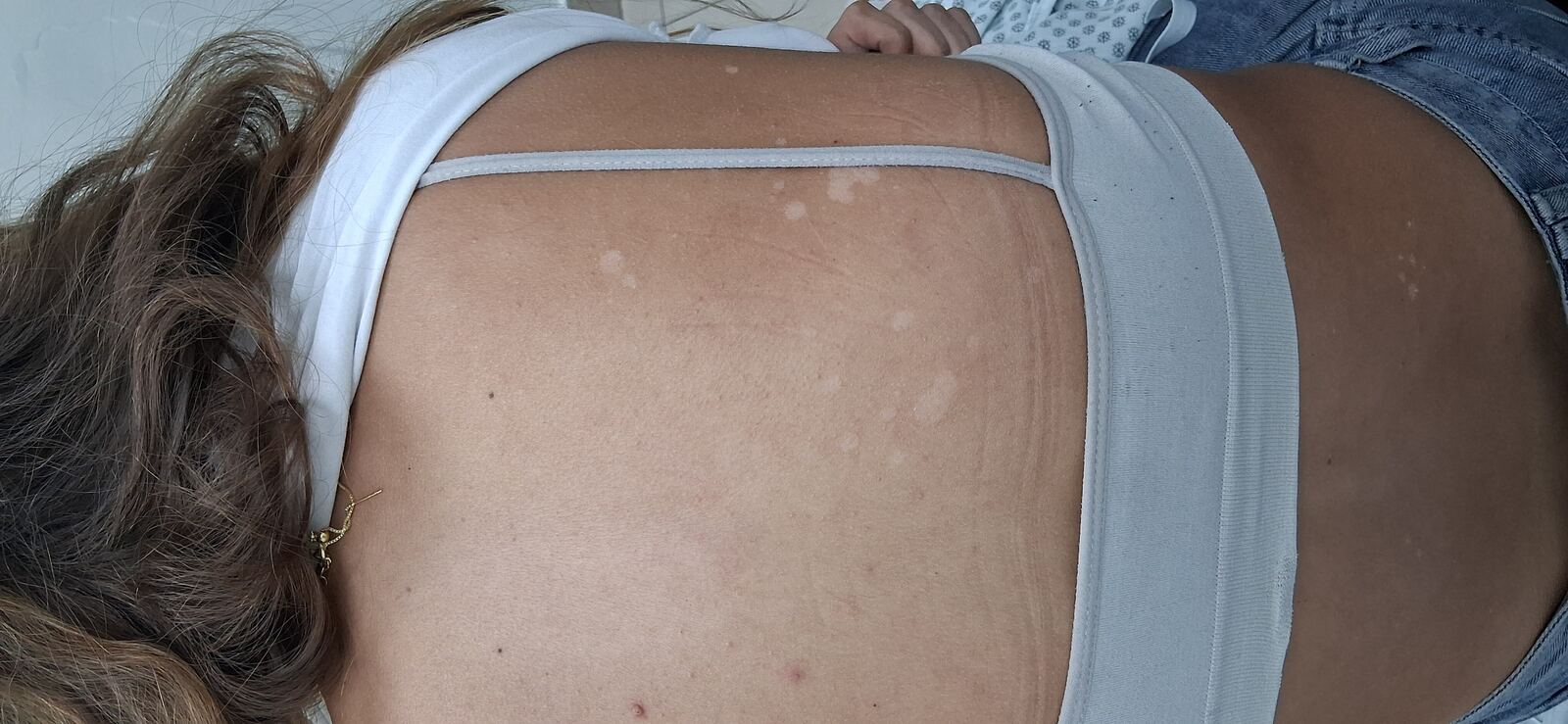 Después - Caso clínico: Pitiriasis versicolor e hipomelanosis guttata
