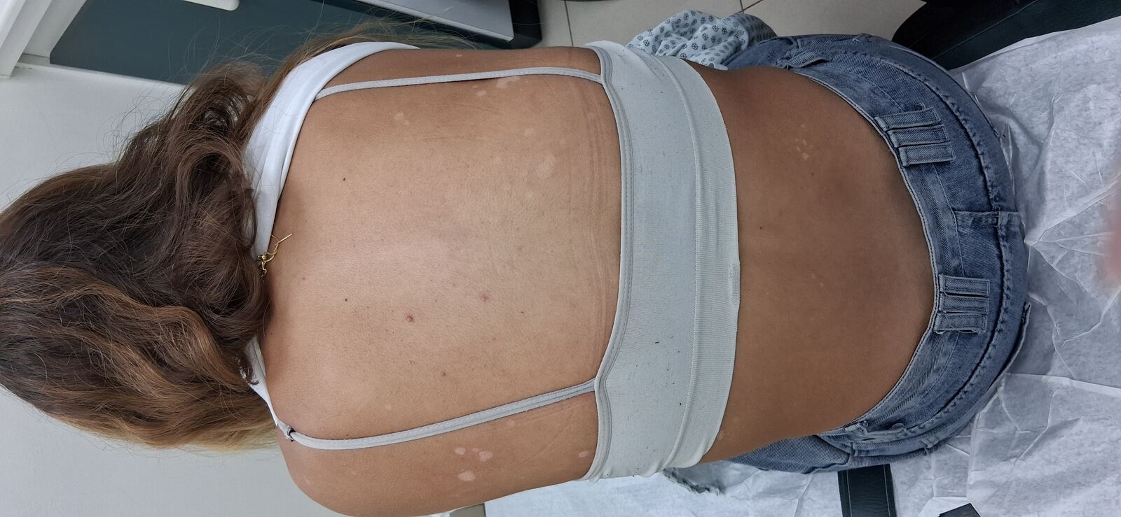 Caso clínico: Pitiriasis versicolor e hipomelanosis guttata