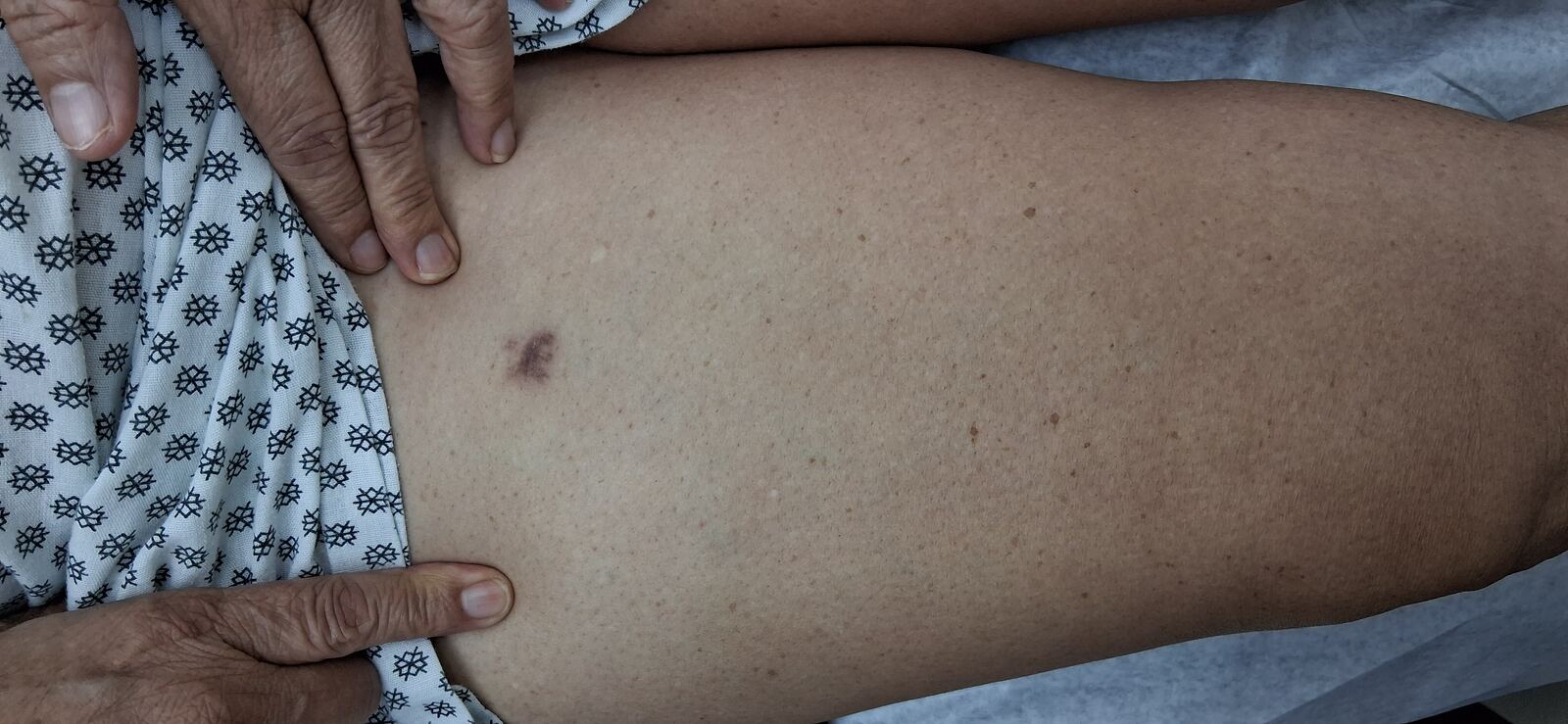Antes - Caso clínico: Post Mohs