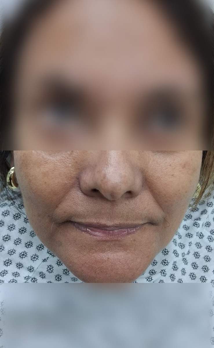 Caso clínico: Post Mohs