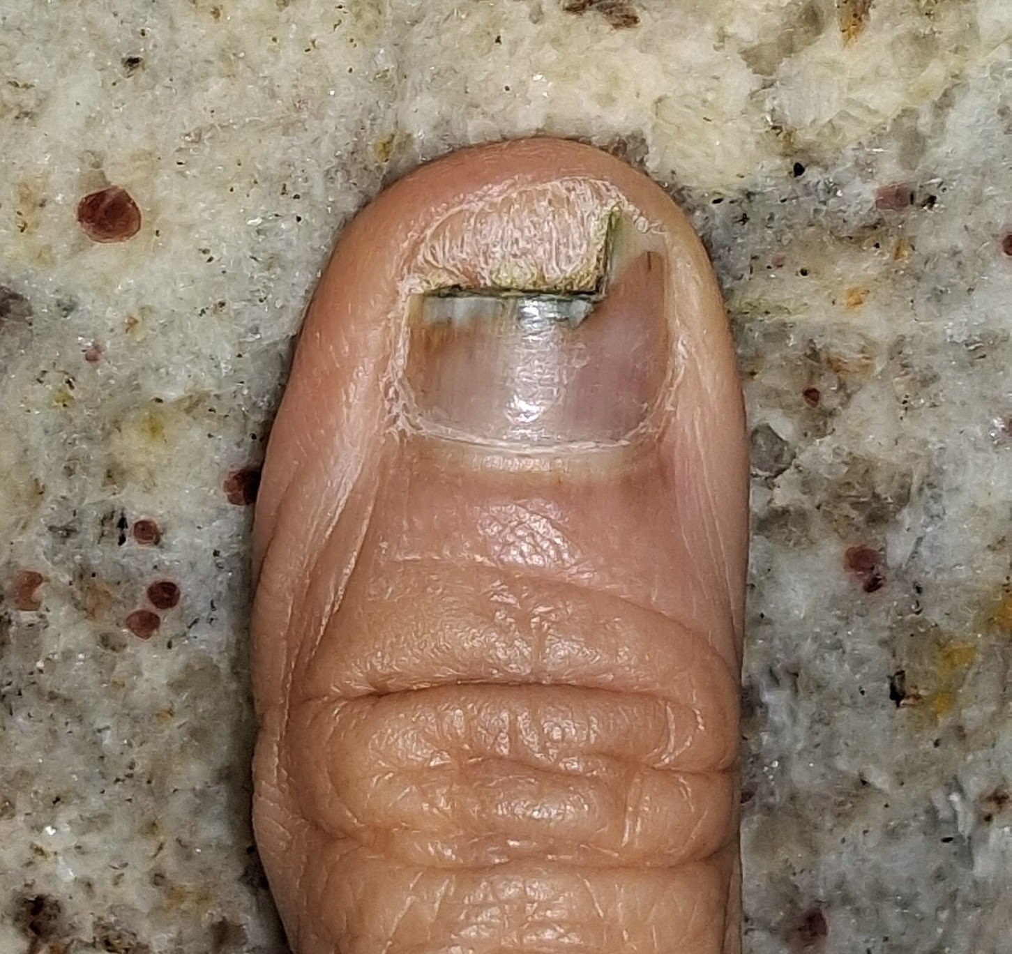 Pseudomonas: imagen antes