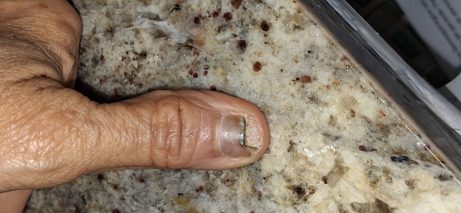 Caso clínico: Pseudomonas