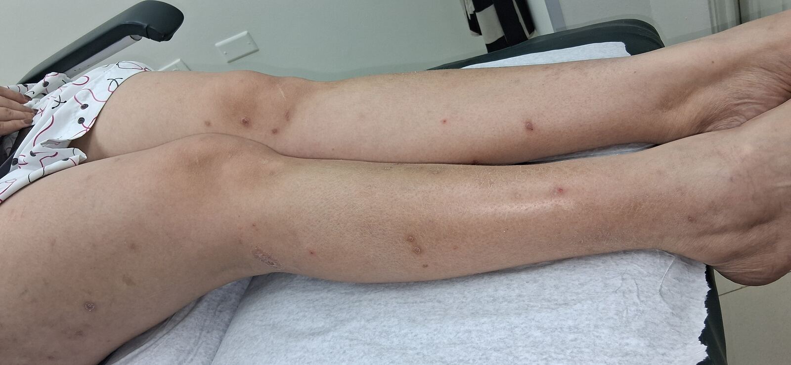 Antes - Caso clínico: Psoriasis guttata