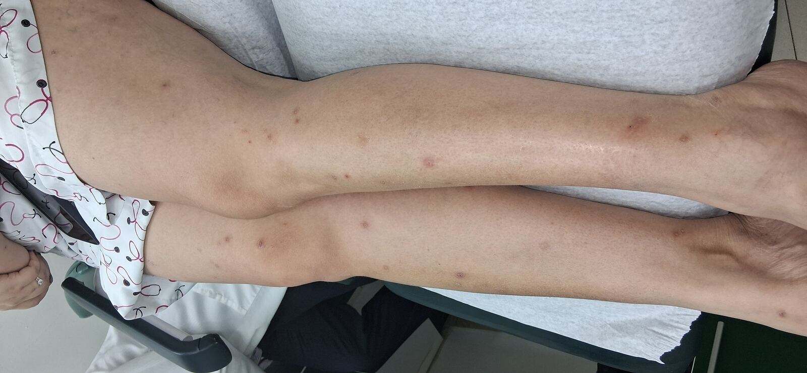 Después - Caso clínico: Psoriasis guttata