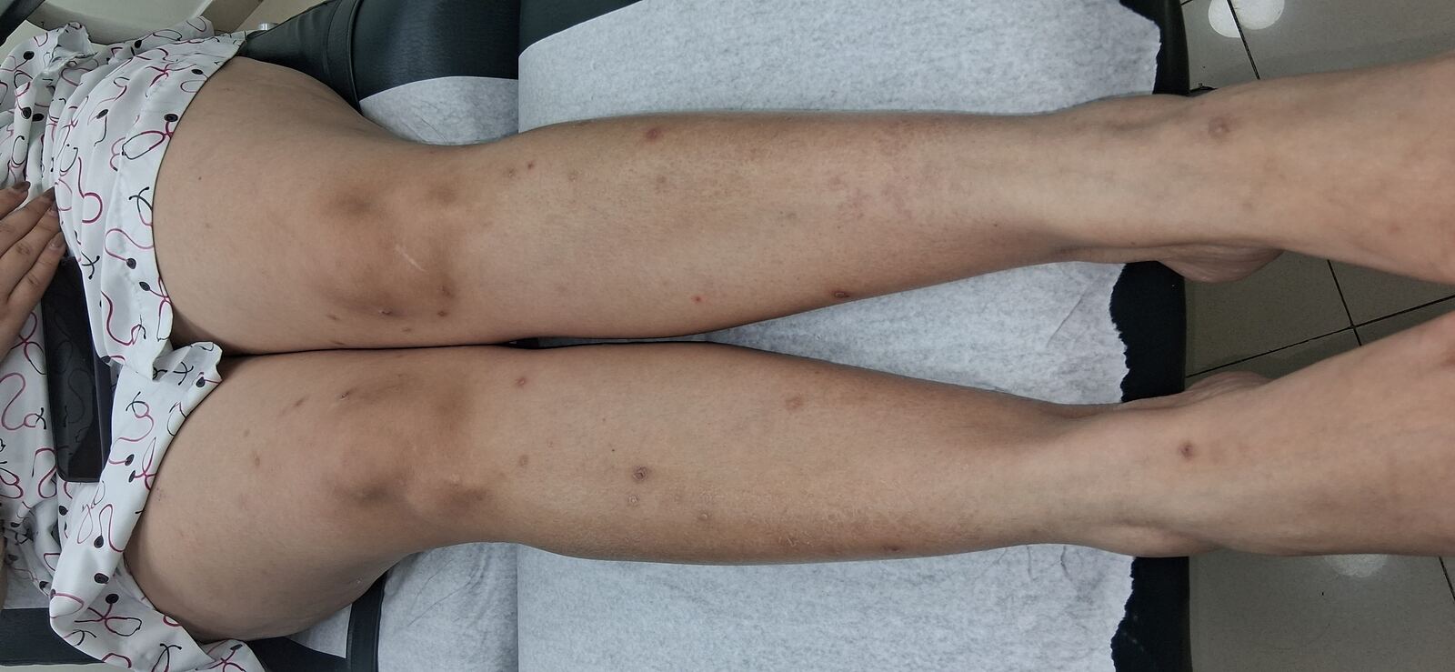 Caso clínico: Psoriasis guttata