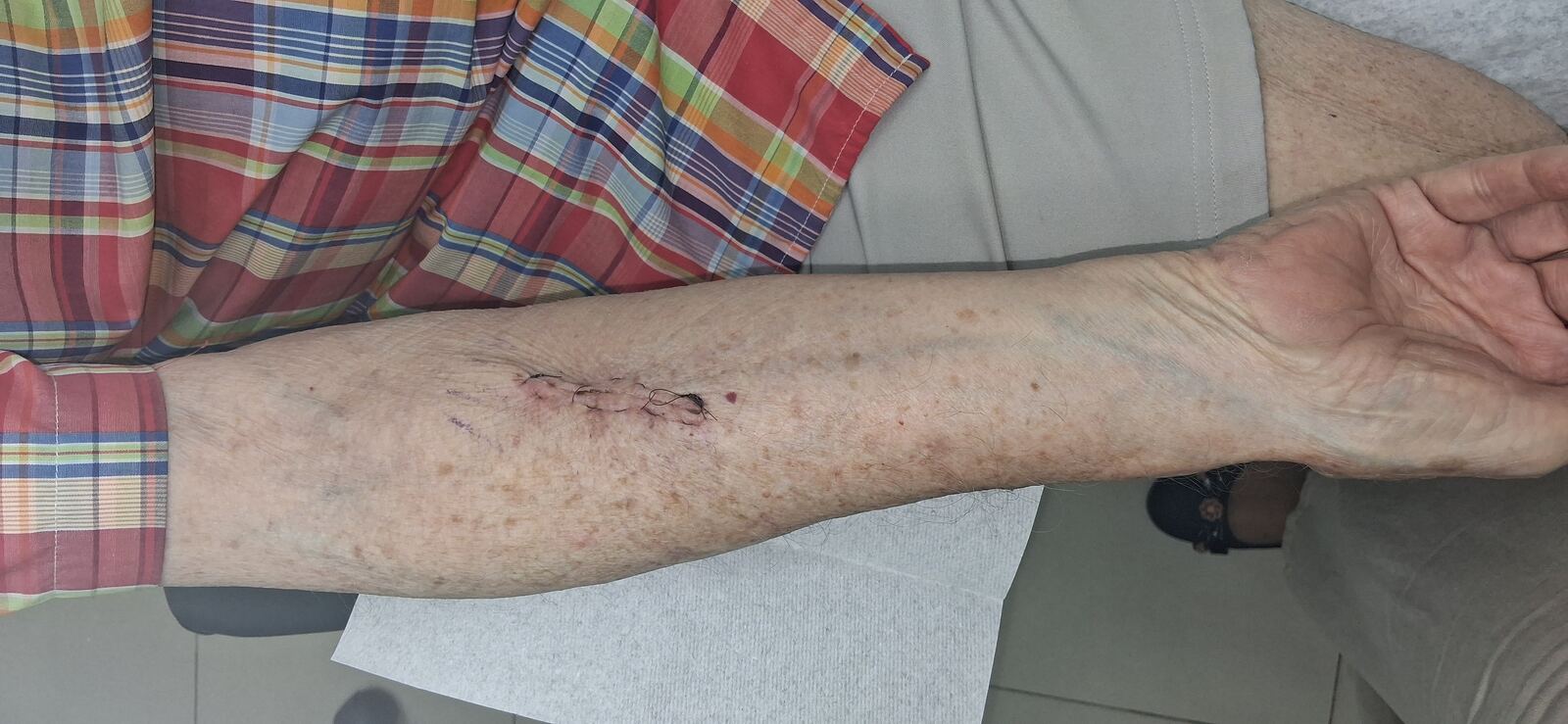 Antes - Caso clínico: Queratoacantoma