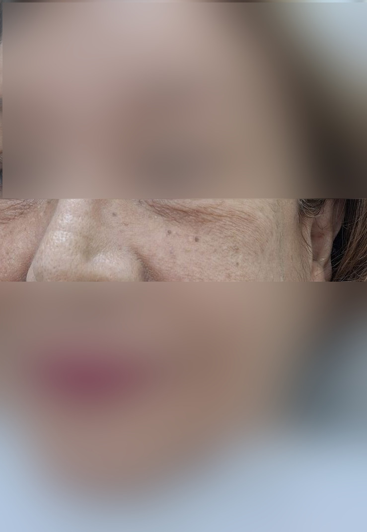 Antes - Caso clínico: Queratosis actínica