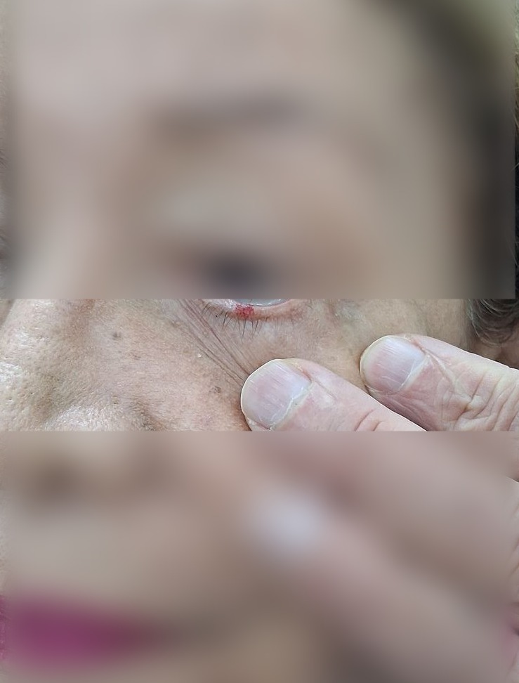 Después - Caso clínico: Queratosis actínica