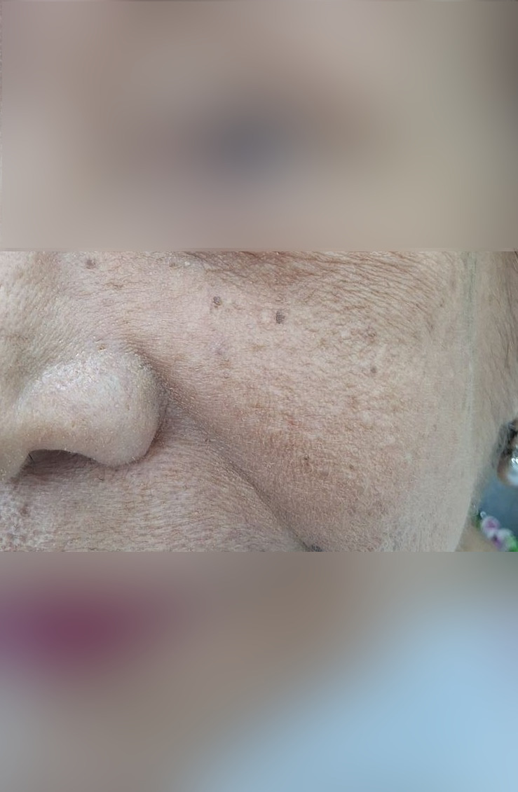 Caso clínico: Queratosis actínica