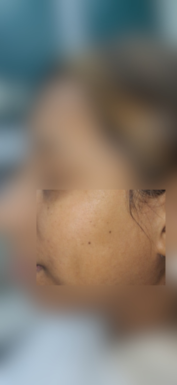 Antes - Caso clínico: Queratosis seborreica
