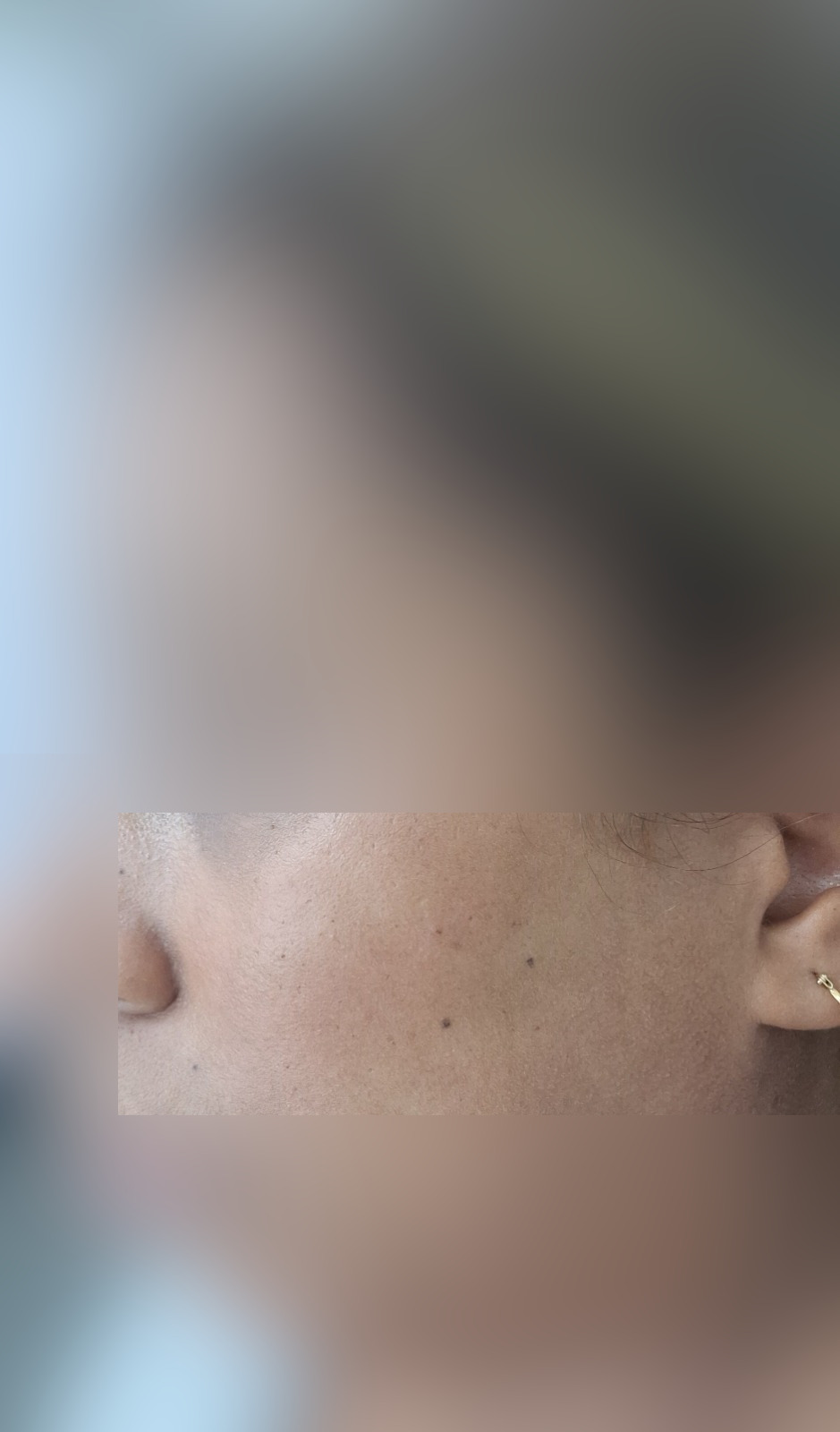 Después - Caso clínico: Queratosis seborreica