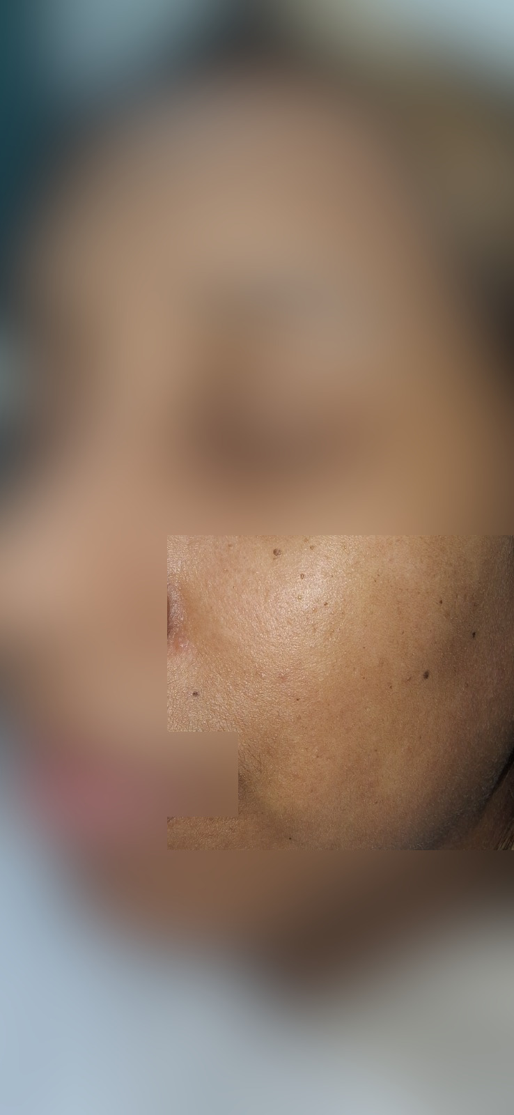 Caso clínico: Queratosis seborreica