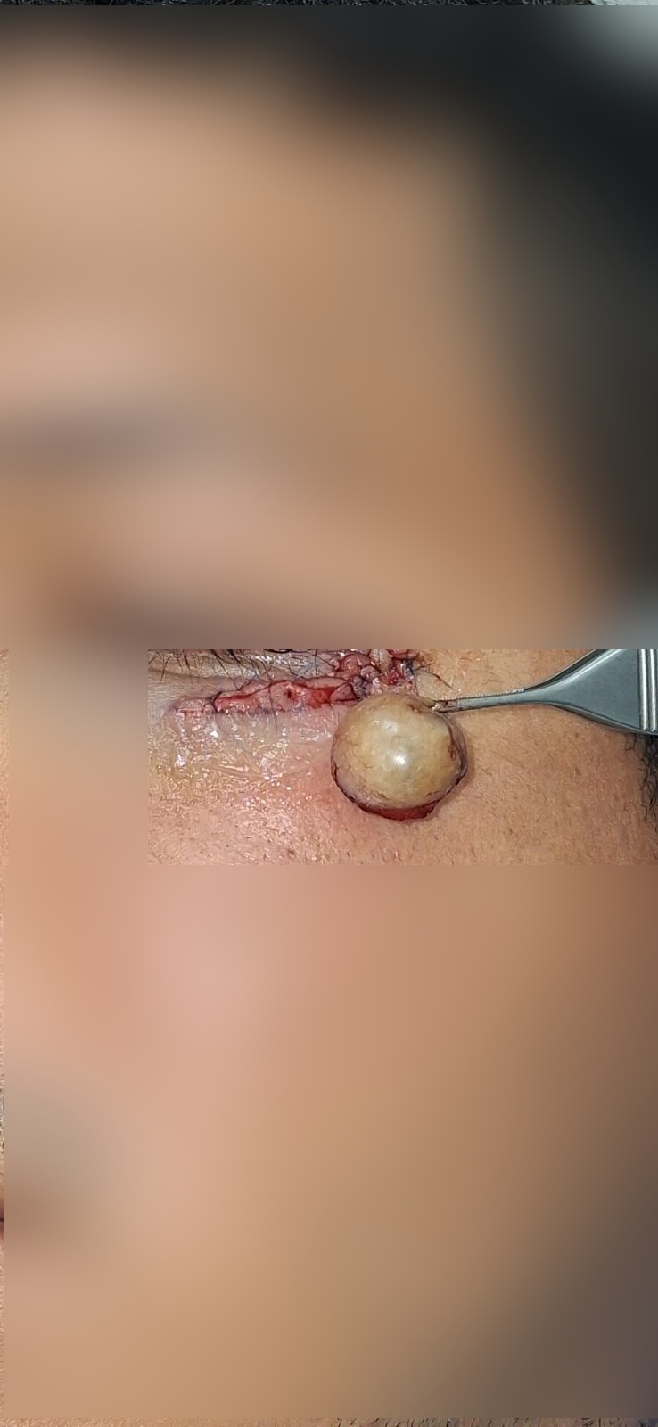 Antes - Caso clínico: Quiste epidermoide