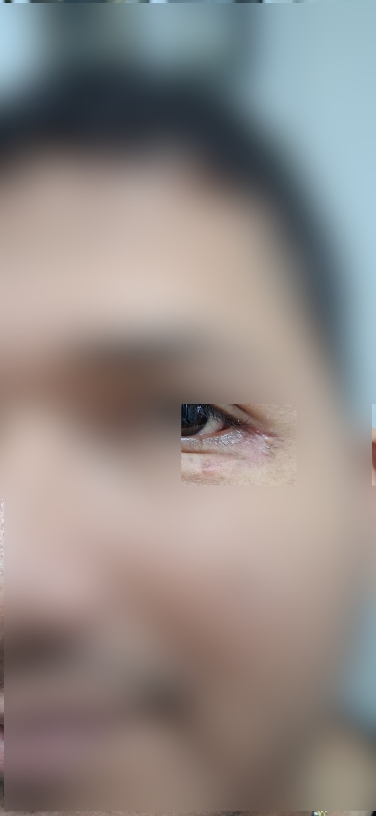 Después - Caso clínico: Quiste epidermoide