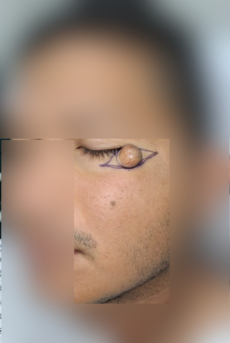 Caso clínico: Quiste epidermoide