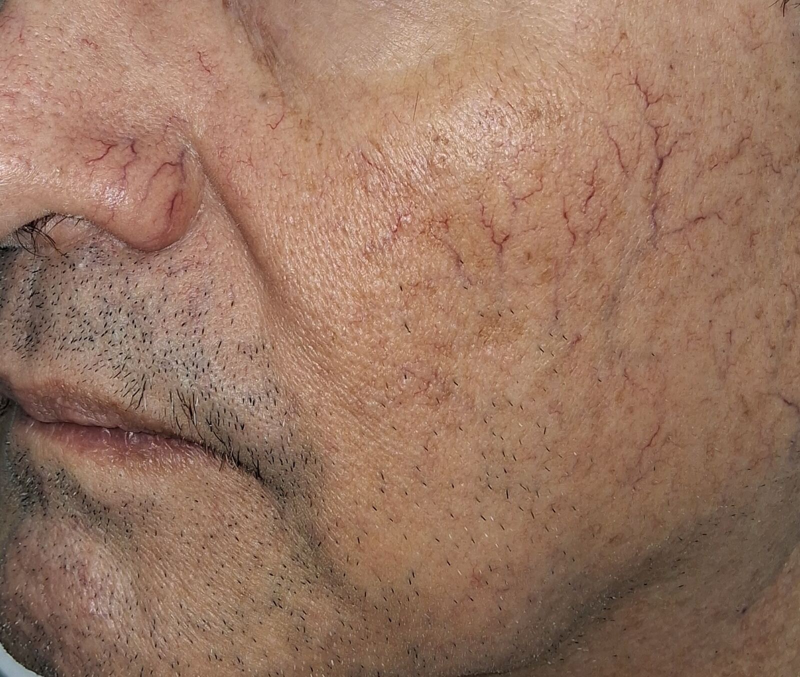 Antes - Caso clínico: Rosácea telangiectásica y Demodex