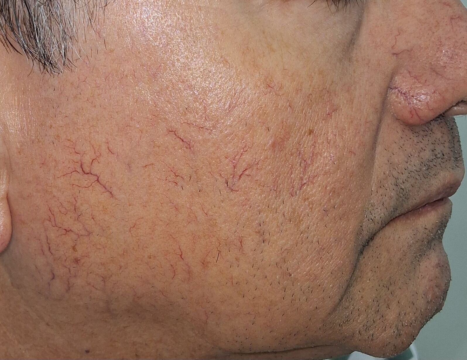 Después - Caso clínico: Rosácea telangiectásica y Demodex