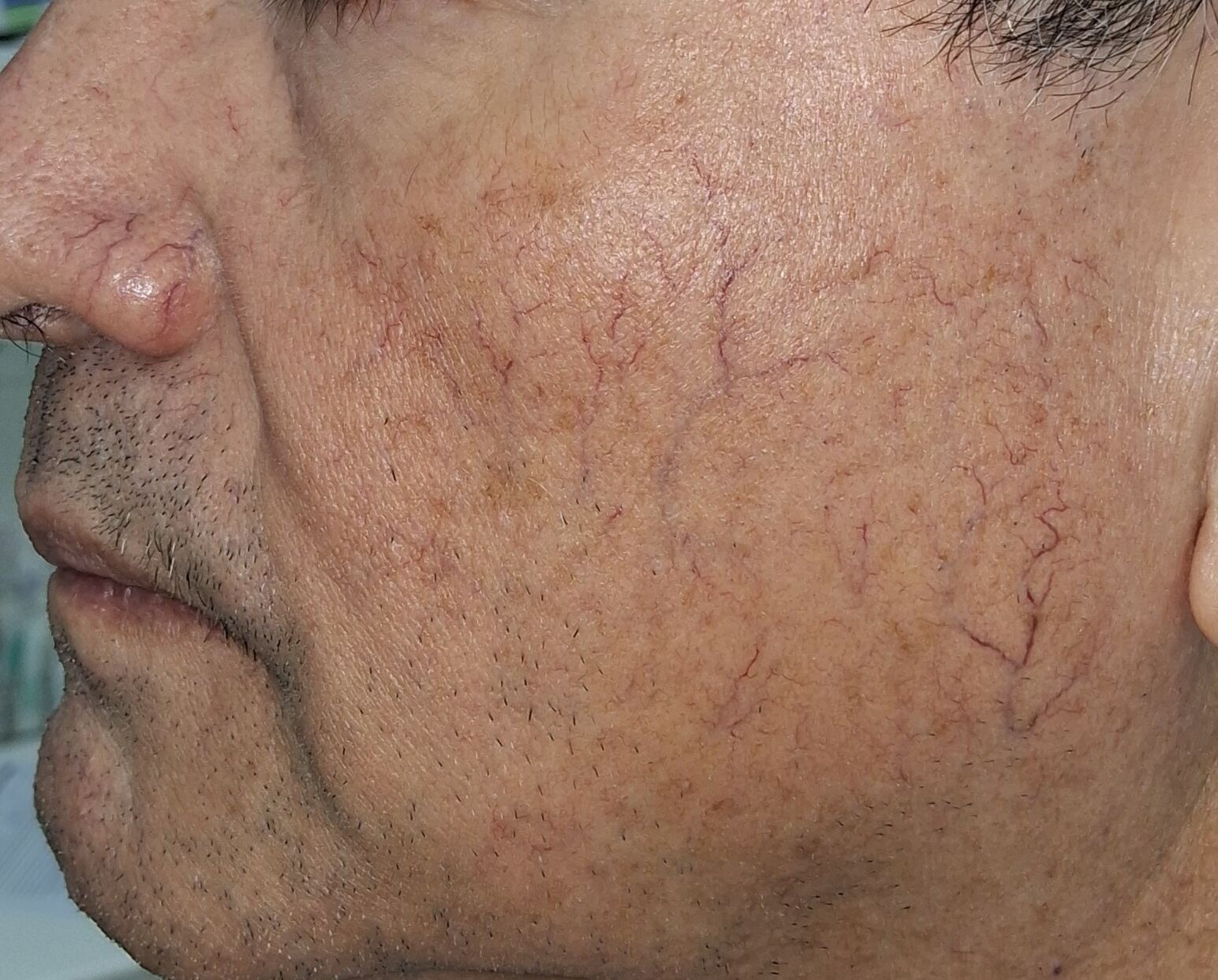 Caso clínico: Rosácea telangiectásica y Demodex