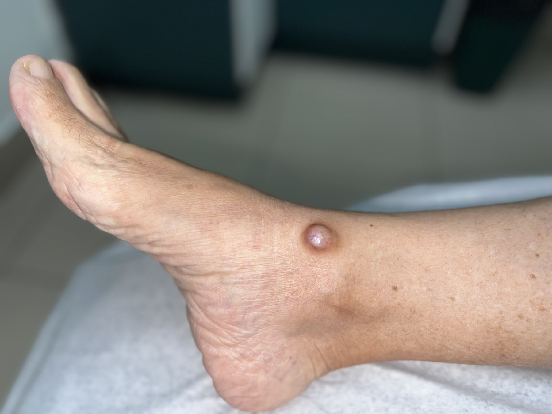 Caso clínico de Tumor mixto