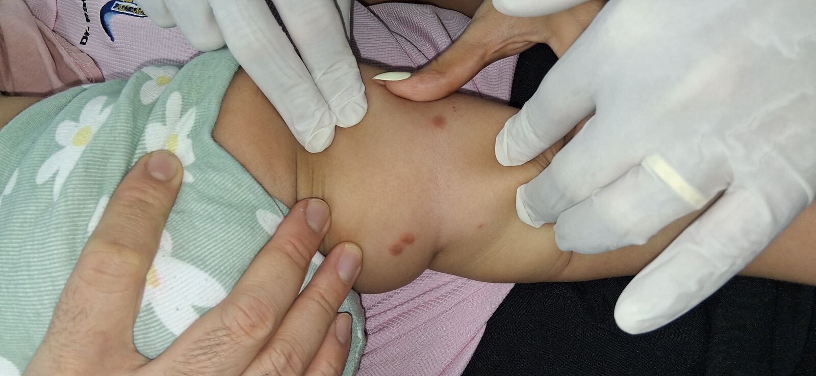 Antes - Caso clínico: Urticaria papular, mastocitosis y linfocitosis cutis