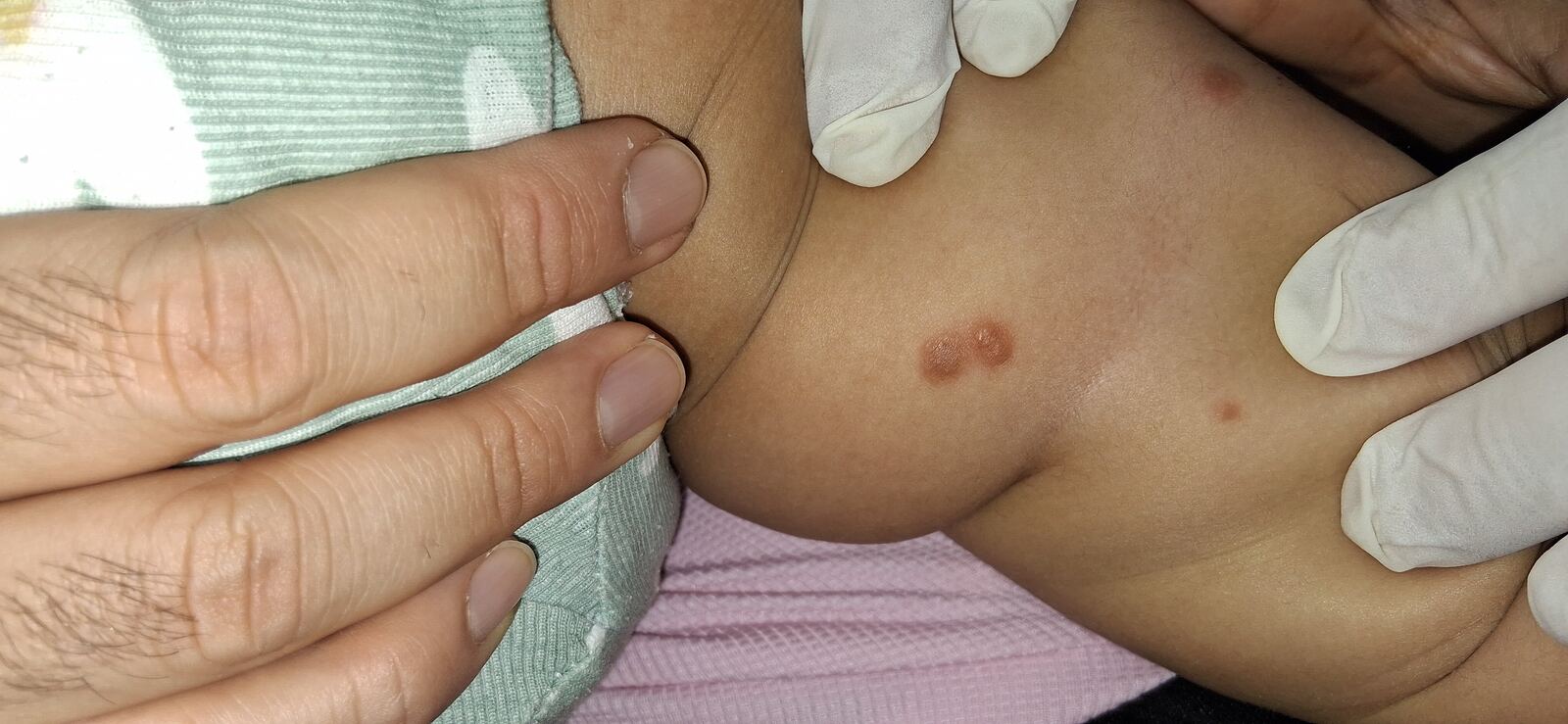 Después - Caso clínico: Urticaria papular, mastocitosis y linfocitosis cutis