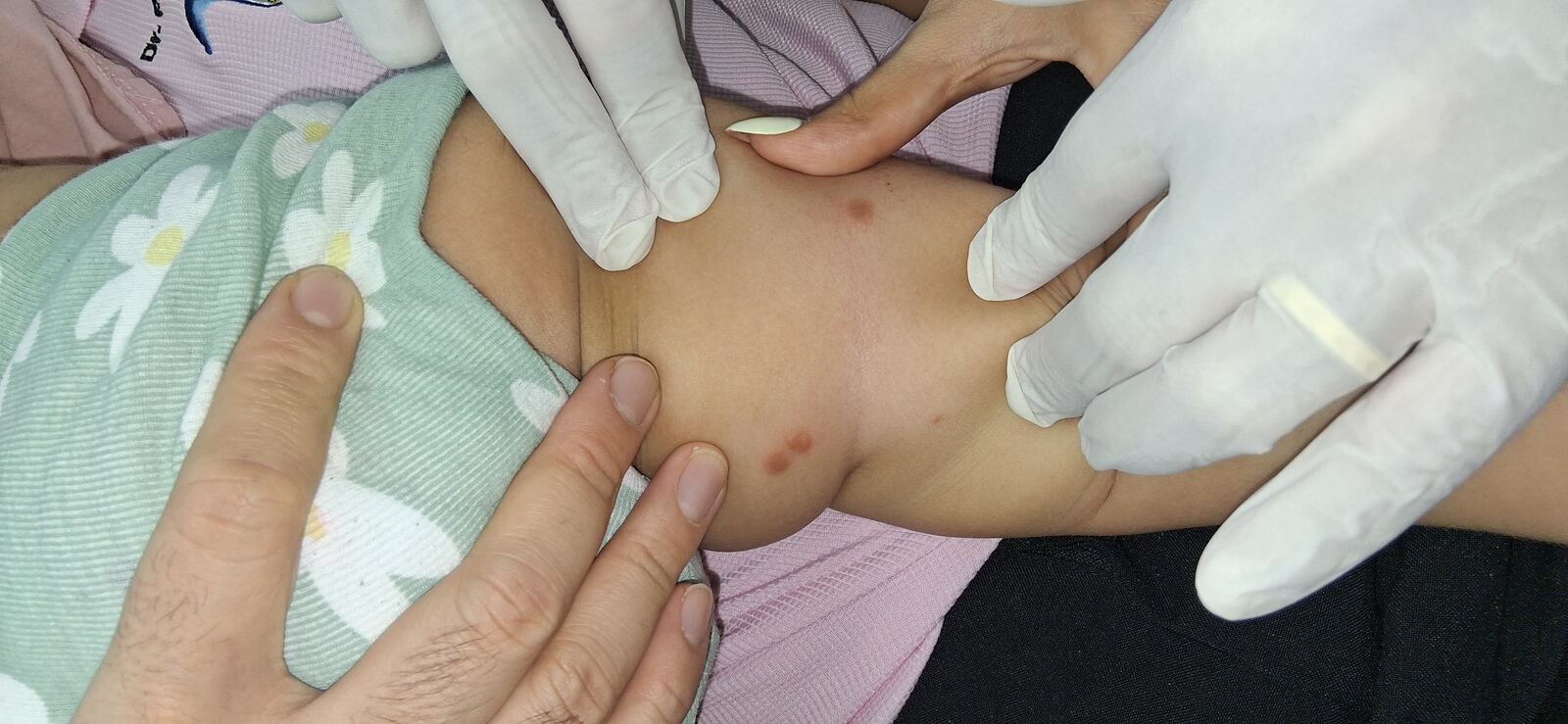 Caso clínico: Urticaria papular, mastocitosis y linfocitosis cutis