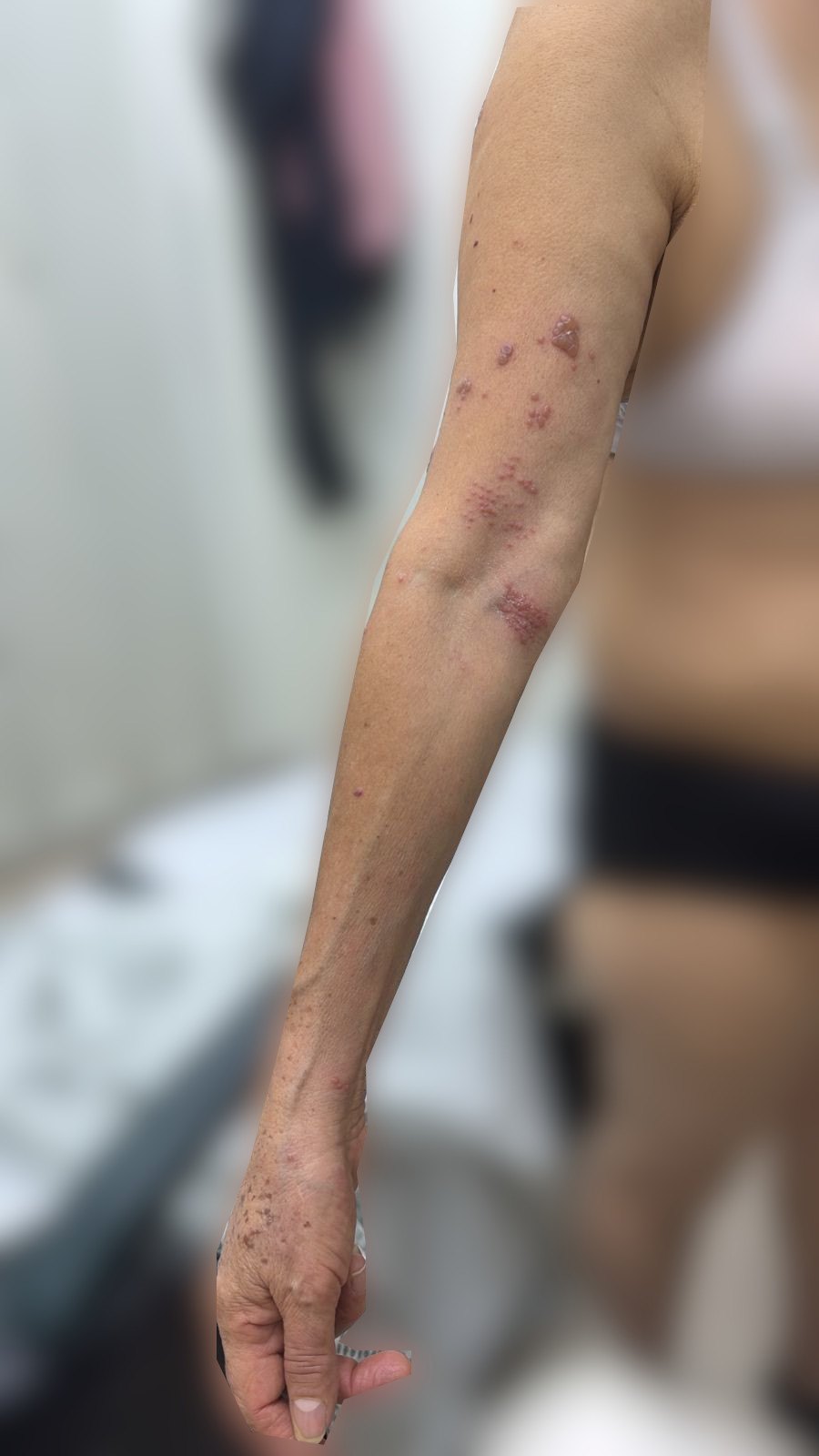 Varicela zoster: imagen antes