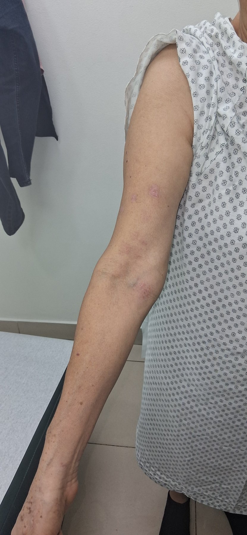 Varicela zoster: imagen después