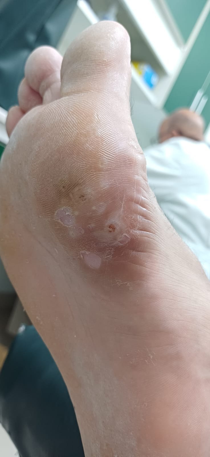 Verruga plantar: imagen antes
