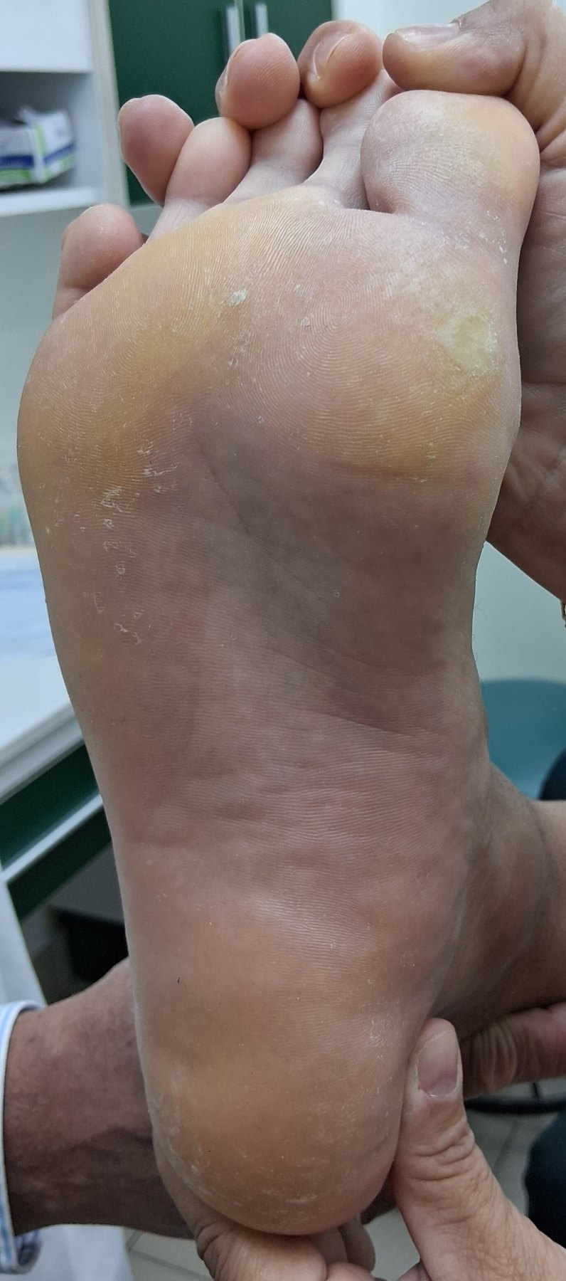 Verruga plantar: imagen después