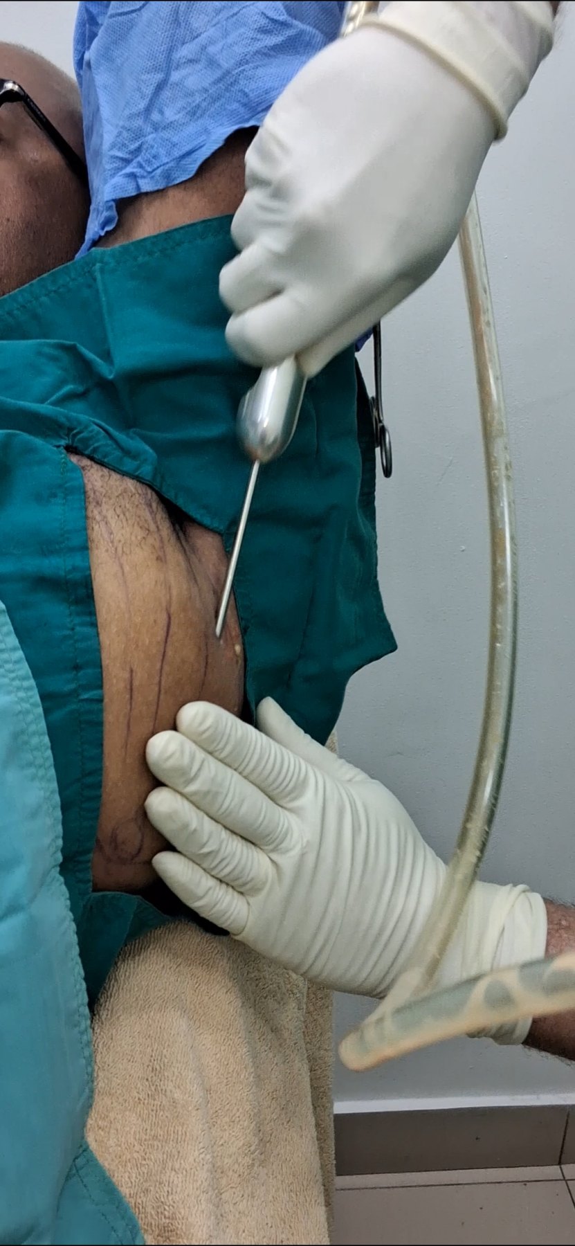 Antes: Lipoma