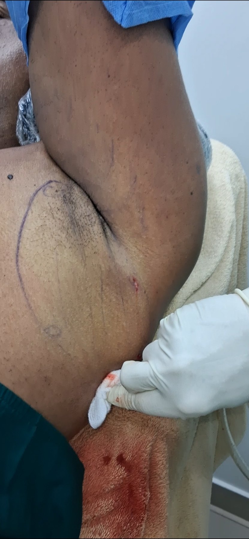 Después: Lipoma