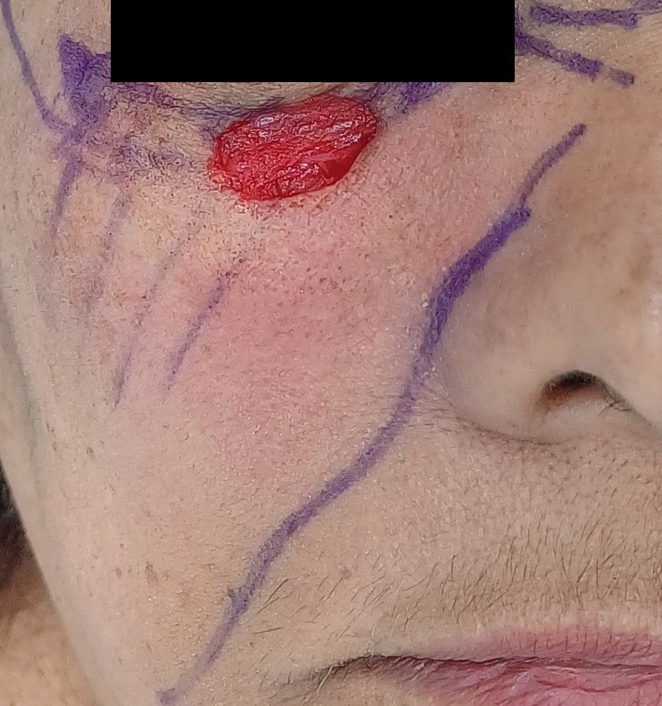 Antes: Cirugía de Mohs con control microscópico y reconstrucción
