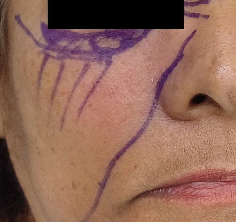 Cirugía de Mohs con control microscópico  y reconstrucción