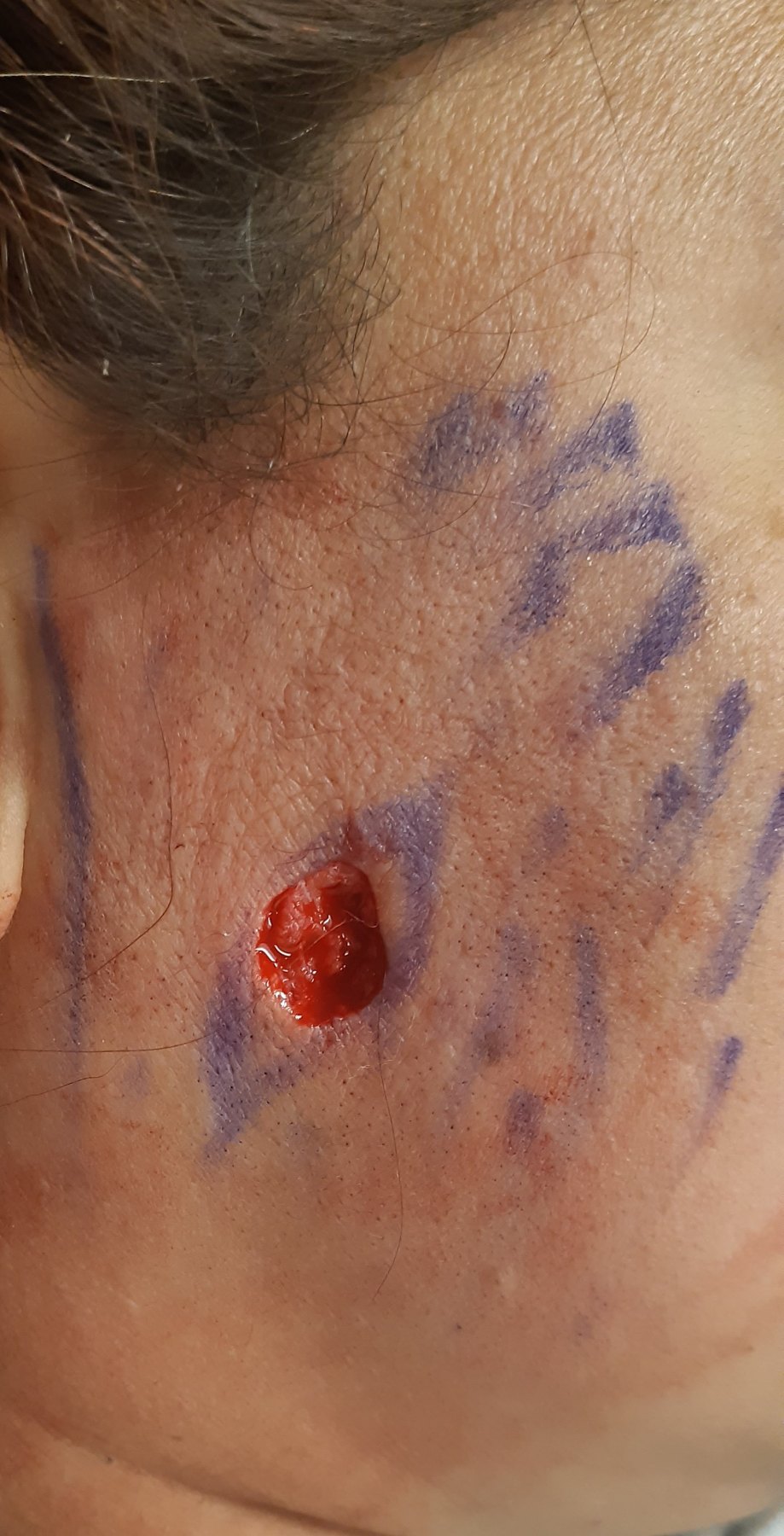 Antes: Cirugía de Mohs con control microscópico y reconstrucción