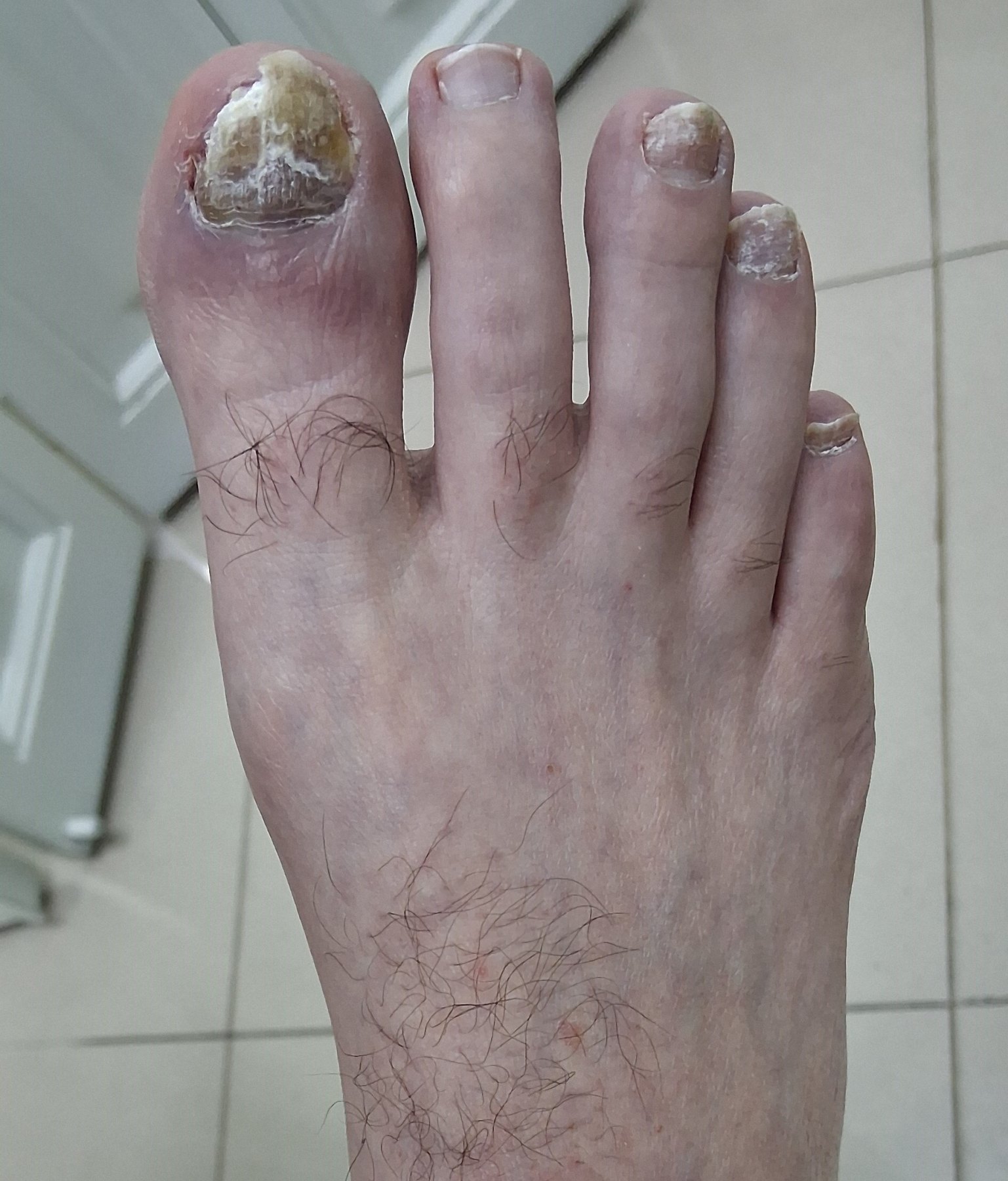 Onicomicosis del pie