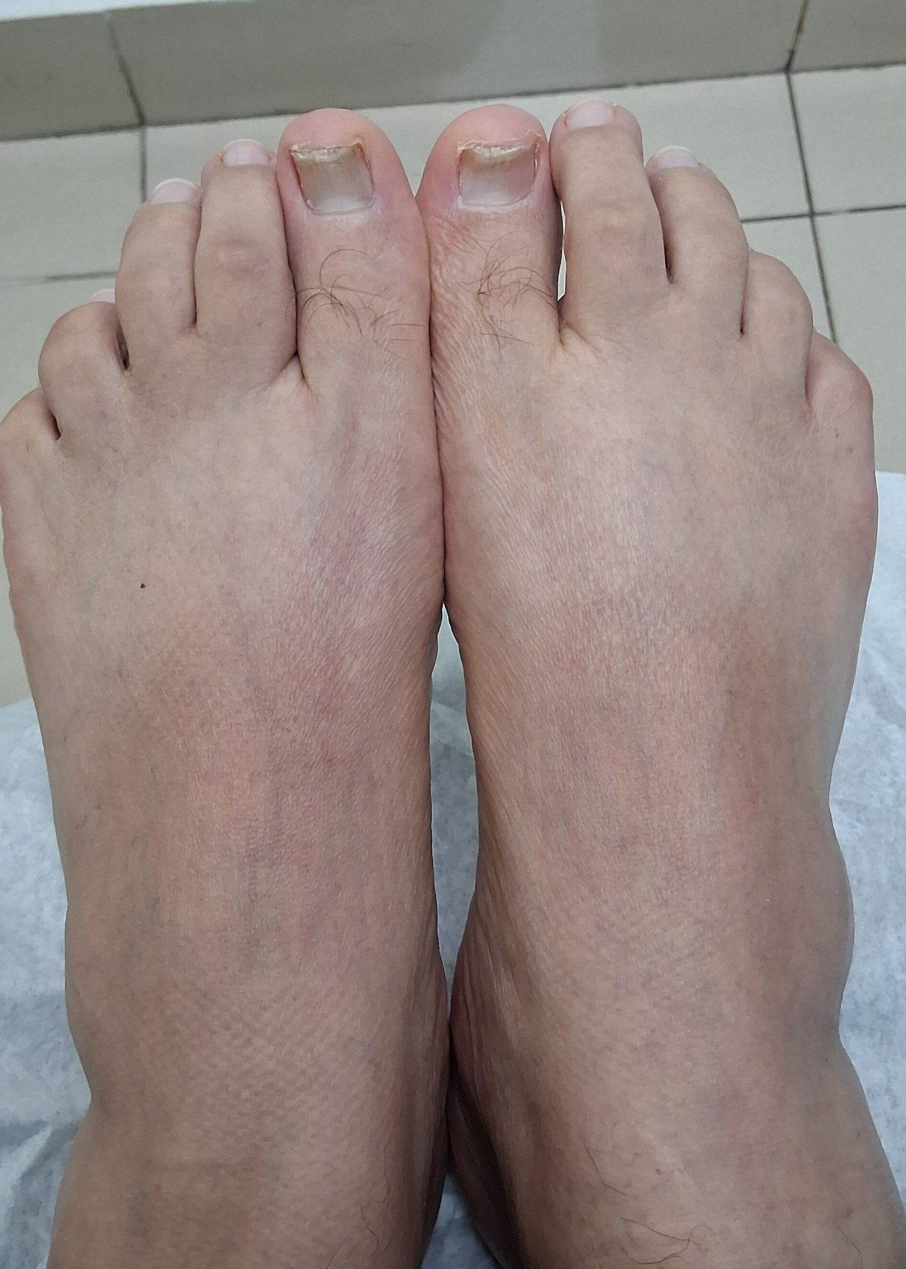 Después: Onicomicosis del pie